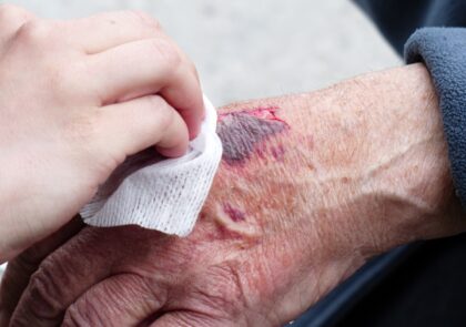 Kuvituskuvassa puhdistetaan kädessä olevaa haavaa.